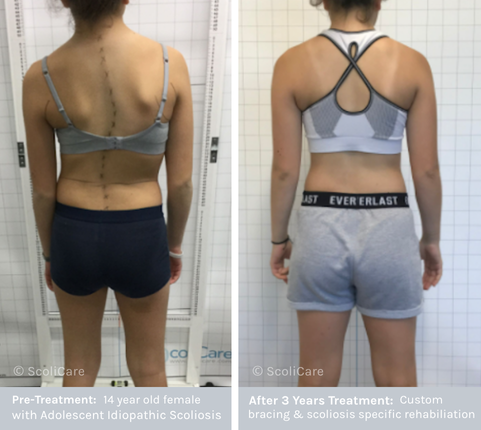 Adolescent Idiopathic Scoliosis