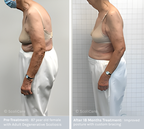 Adult Scoliosis