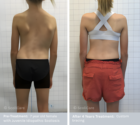 Juvennile Scoliosis